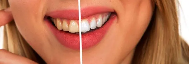 牙齿美白.